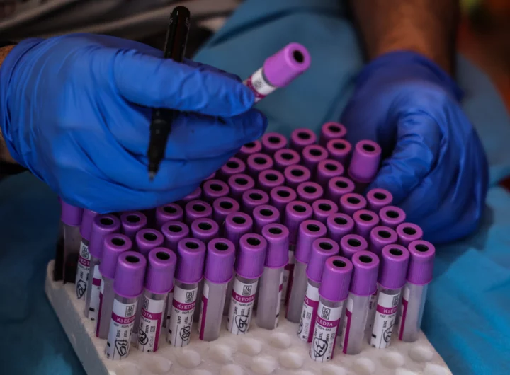 Revolutionary Blood Test Detects Cancer Recurrence with AI-Powered Precision